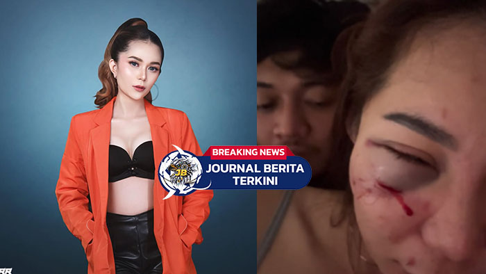 [VIDEO] Alami Luka M3m4r di Wajah! DJ di Malang Dianiaya Pacar Lapor Polisi